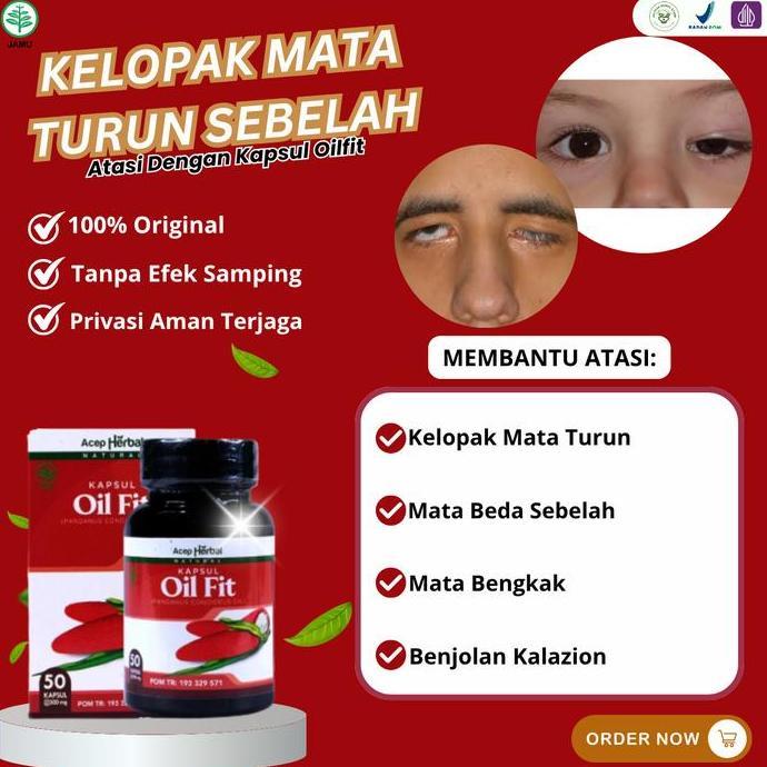 DEAL TERBAIK - Oiflit Untuk Atasi Mata Ptosis Lipatan Kelopak Mata Turun Sebelah Mata Sipit Sebelah 
