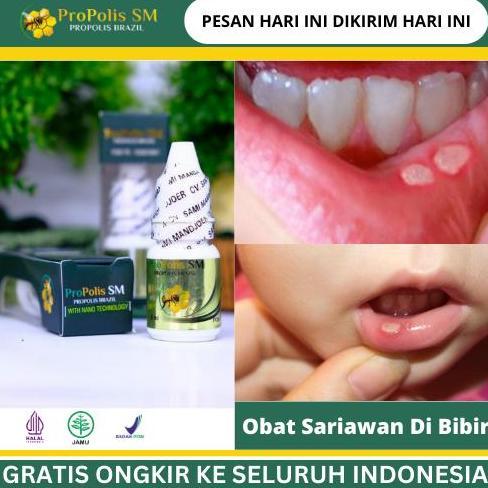 HOT DEAL - Solusi Penyembuhan Sariawan di Bibir, Bibir Sakit Dan Gatal, Bibir Bengkak, Bibir Kering,