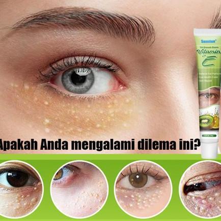 Akbar_Saerun - Cream Milia Penghilang Milia Paling Ampuh Krim Penghilang Milia Syringoma Xanthelasma
