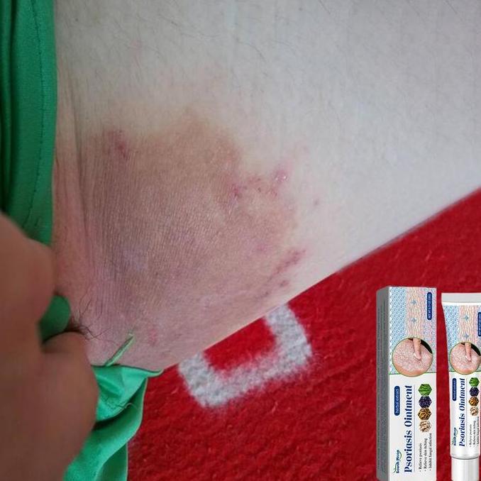 Youme- Krim Gatal Kulit Penyakit Kulit Gatal Seluruh Badan