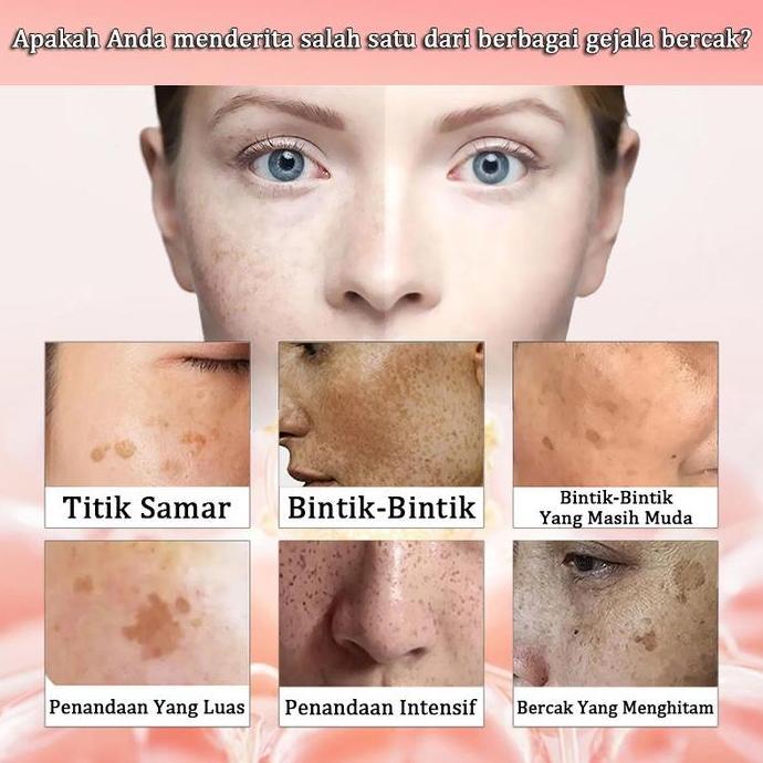 Youme- Cream Penghilang Flek Hitam Membandel Penghilang Flek Hitam Serum,Cream Penghilang Flek Hitam