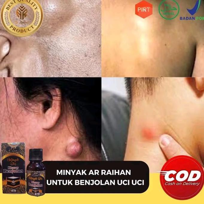 Muskel- Minyak Herbal Oles Untuk Benjolan Tubuh Di Semua Area Minyak Oles Khusus Benjolan Alami