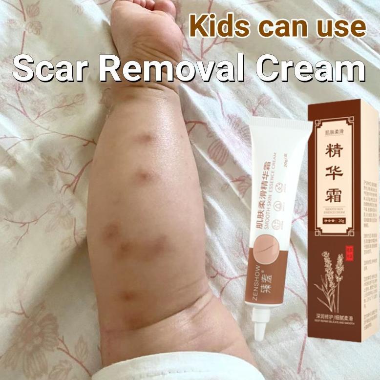 Penghilang bekas luka bayi Krim kaki hitam Penghilang bekas luka hitam koreng Menghilangkan bekas lu
