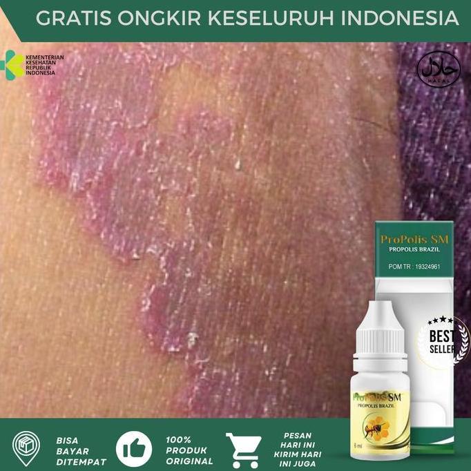 Propolis SM Salep Jamur Kulit Selangkangan, Gatal Selangkangan