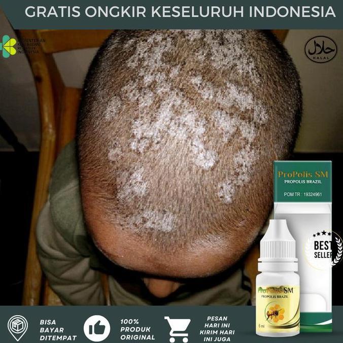 Tinea Capitis Pada Anak, Tinea Cruris, Tinea Capitis Jamur Kepala Anak, Borok Kepala, Jamur Kulit Ke