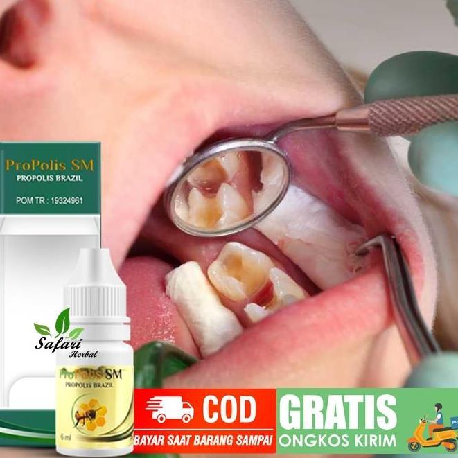 Obat Kumur Penghancur Gigi Berlubang, Perontok Karang Gigi-PROPOLIS SM