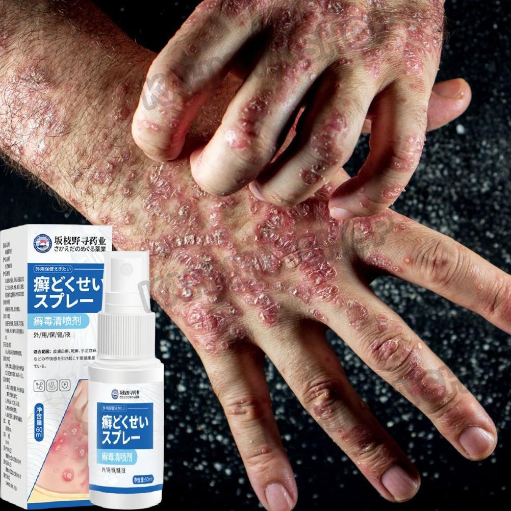 Terlaris Salep gatal paling ampuh Obat psoriasis obat gatal salep kutil Obat Gatal Salep gatal Salep