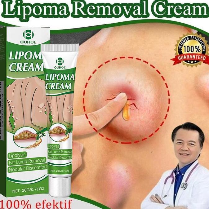 Lipoma Cream Obat Benjolan Subkutan Lipoma Removal Cream Obat Salep Benjolan Lipoma Ampuh Herbal sal