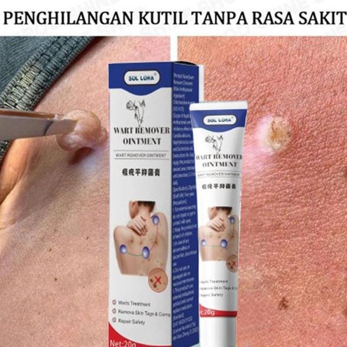 Care- Penghilang Tahi Lalat Dan Kutil 20G Penghilang Kutil Paling Ampuh Penghilang Kutil Obat Kutil 