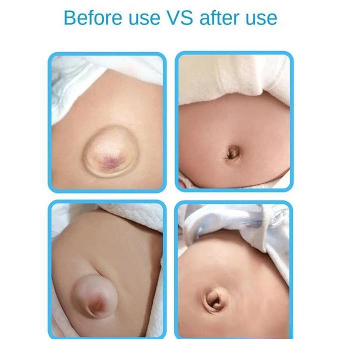 Hernia Xiaokang Bayi Hernia Patch Pusar Convex Pusar Patch Hernia Cembung Inguinalis Patch Umbilical