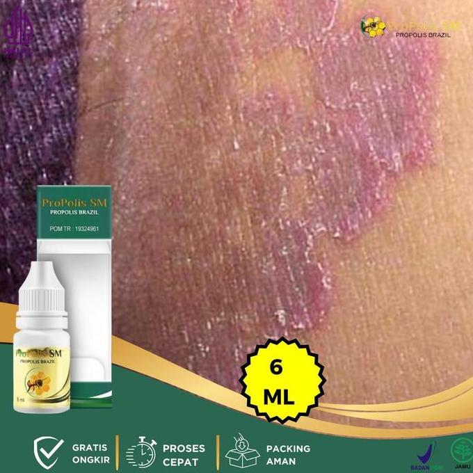 Gatal Selangkangan, Selangkangan Hitam, Selangkangan Gatal Dan Hitam, Ruam Merah Selangkangan, Pemut