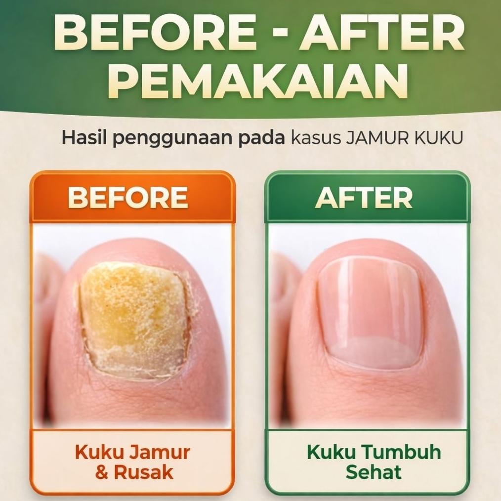Sale Hermoralux Obat Kuku Berjamur Cantengan Kuku Kuning Rusak Penebal Kuku Serum Perawatan Kuku Tan