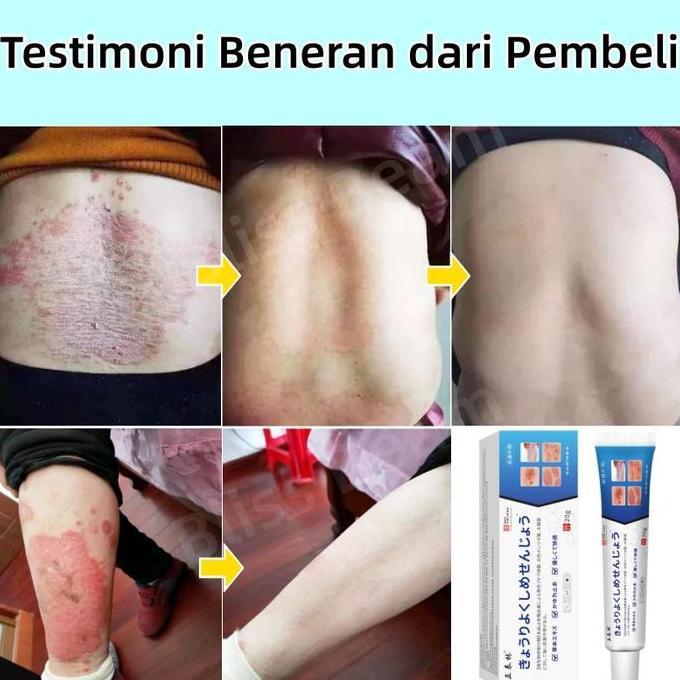Skinyou- Salep Gatal Selangkangan Salep Eksim Saleb Gatal Paling Ampuh Menghilangkan Kurap Dan Jamur