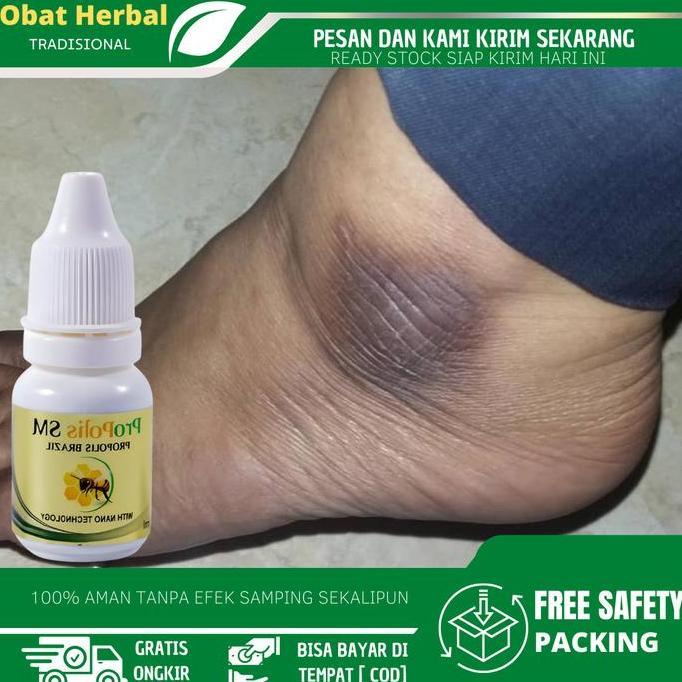 opaljavanes99  - perawatan mata kaki hitam, salep mata kaki hitam, mata kaki kering kasar, mata kaki