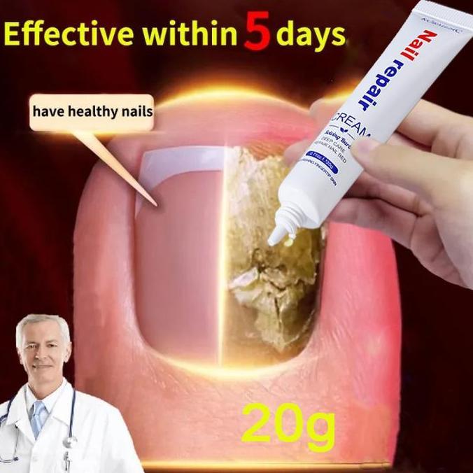 Nail- Obat Kuku Jamur Dan Rusak Obat Jamur Kuku 20G Obat Kuku Rusak Paling Ampuh Obat Penumbuh Kuku 