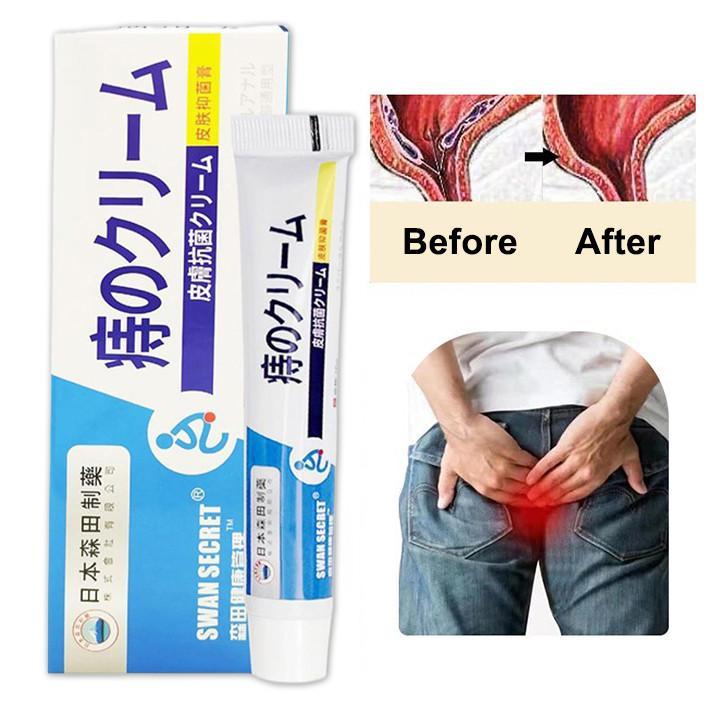 Japan Obat wasir/Obat ambeien ambeien paling ambeien 20g/obat ambeien paling /mengobati wasir untuk 