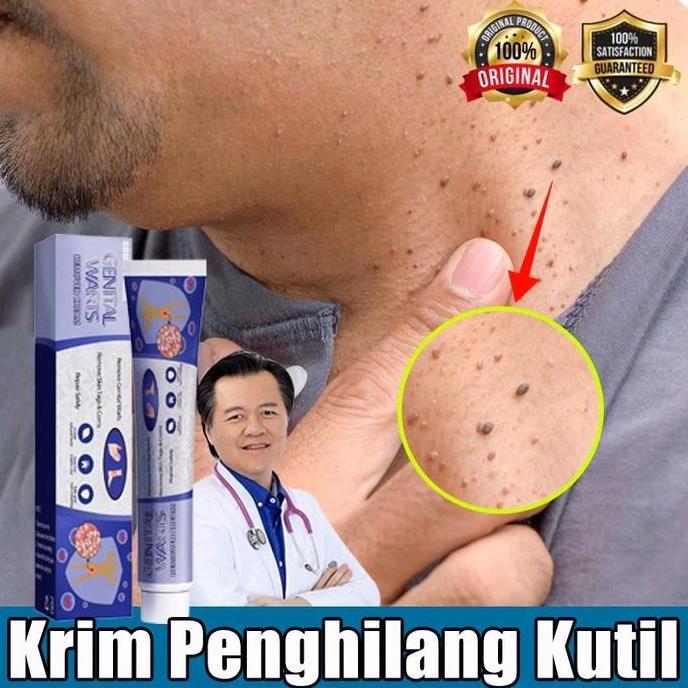 Penghilang Kutil Dan Tahi Lalat Obat Penghilang Kutil Di Wajah Papiloma Wajah Kutil Leher Penghilang