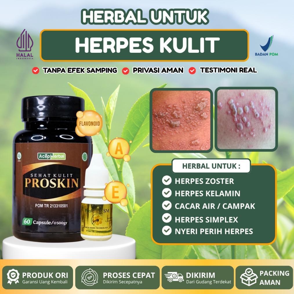 Obat Herpes Zoster, Herpes Kelamin, Herpes Bibir, Herpes Genital Herpes Kulit Herpes Simplex terlari