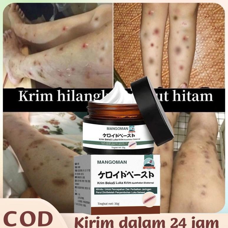 Terlaris Krim Penghilang Bekas Luka Obat Penghilang Bekas Luka Bekas Luka Jahitan Gigitan Serangga B