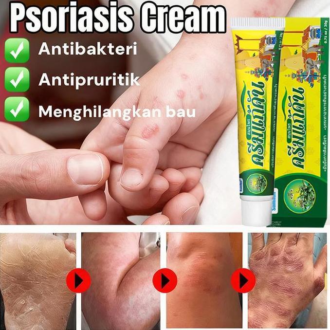 Skinyou- Obat Gatal Paling Ampuh Krim Pereda Gatal Obat Selangkangan Gatal Salep Kurap Paling Ampuh 