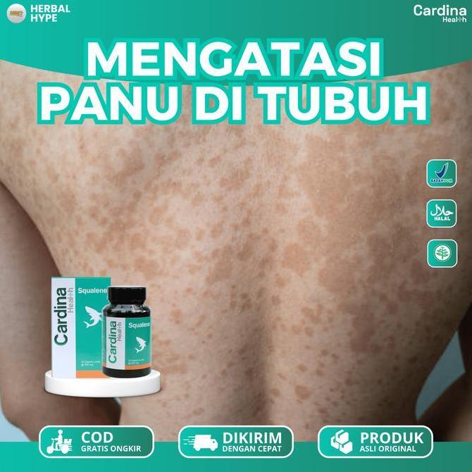 Cardina Squalene Panu Kulit Dan Hapur - Menghilangkan Panu Seluruh Badan Dengan Cardina Squalene Ala