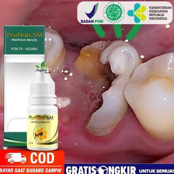 Obat Kumur Pemusnah Gigi Berlubang, Perontok Karang Gigi - PROPOLIS SM