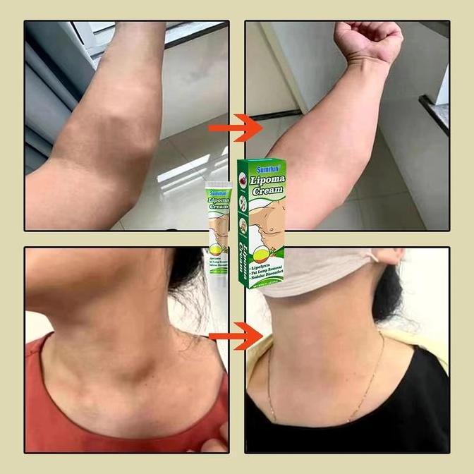 Cream- New- Lipoma Cream Krim Tiroid Obat Hipertiroid P Benjolan Krim Syringoma Lipoma Removal Cream