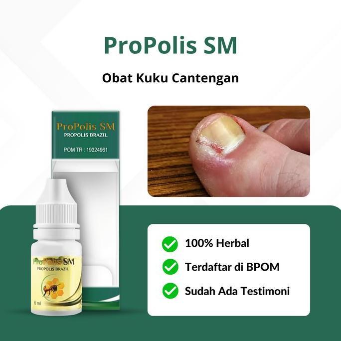 Obat Cantengan Jempol Kaki Bengkak, Obat Jamur Kuku Kaki, Propolis SM