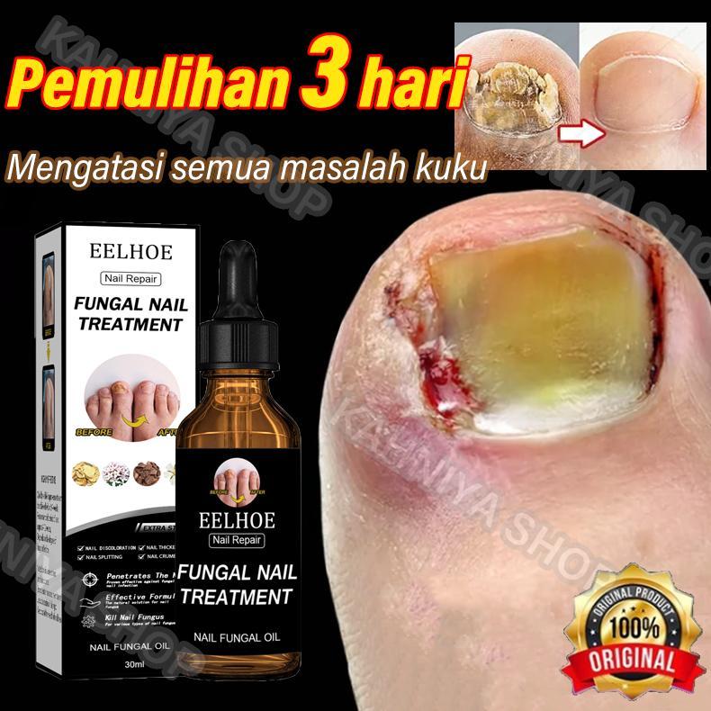 NEW serum kuku obat kuku jamur dan rusak obat kuku jamur dan rusak obat jamur kuku vitamin kuku dan 