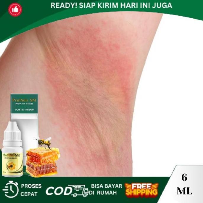 Iritasi Pada Ketiak, Ketiak Gatal, Ketiak Lecet Dan Perih, Gatal Merah Pada Ketiak, Ketiak Berjamur 