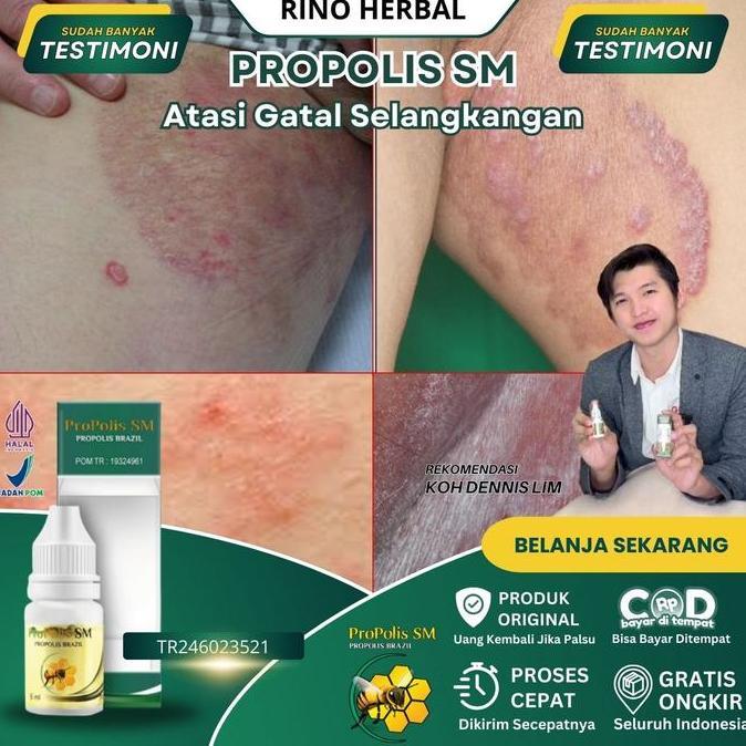 Salep Selangkangan Gatal Hitam, Selangkangan Hitam Dan Gatal, Selangkang Lecet, Jamur Selangkangan, 
