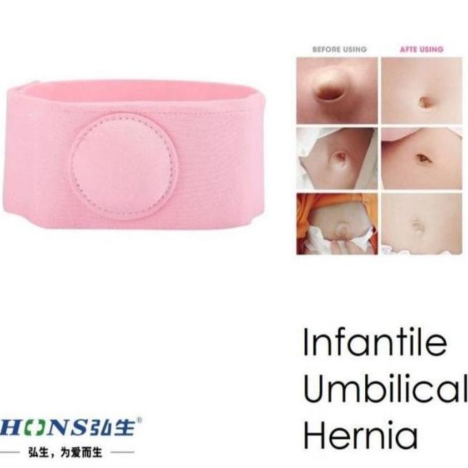 BKL Sabuk Hernia Bayi / Sabuk Pusar Bodong terapi anti udel bodong anak ba
