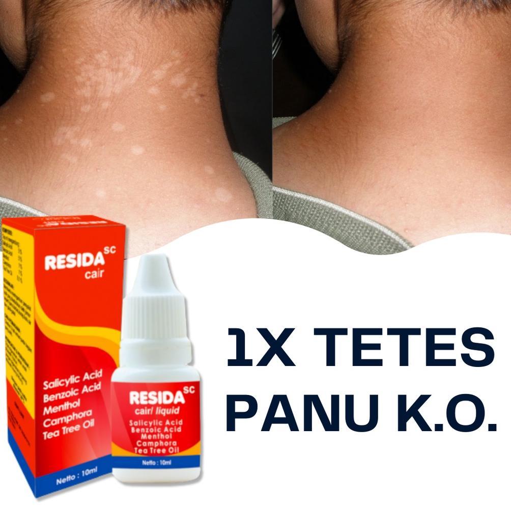 (Terbaru) Resida Cair Obat Penghilang Panu Di Badan Paling Ampuh 100% Obat Hapur Kulit Paling Ampuh 