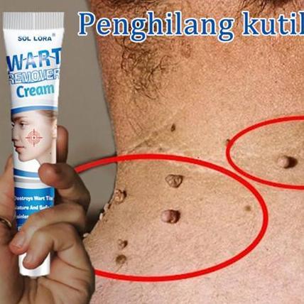 Skinyou- Cod -Promo Obat Kutil Paling Ampuh Penghilang Kutil Dan Tahi Lalat Penghilang Kutil Paling 