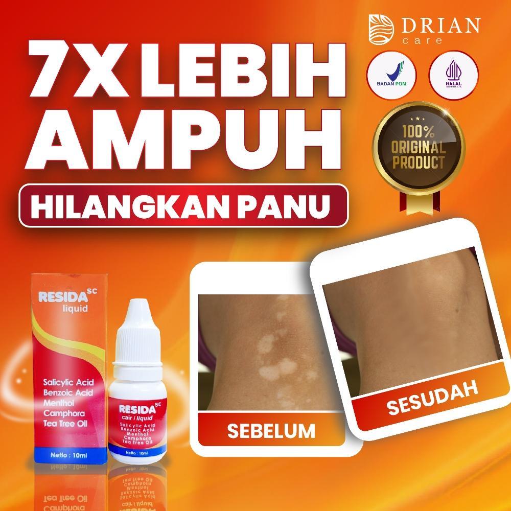 Resida Obat Panu Gatal Kulit Paling 100% Dan Paling Cepat Obat Panu Gatal Kulit Kadas Kurap Kutu Air