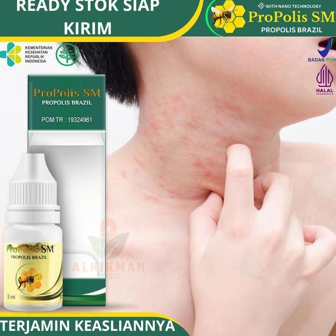 Propolis SM - Untuk Gatal Biang Keringat / Miliaria Gatal Ruam Kecil Kemerahan Untuk Anak Dan Dewasa
