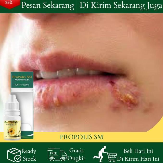 Cairan  Oles Penghilang Herpes Bibir Bintik Bintik Putih Di Bibir, Bibir Gatal