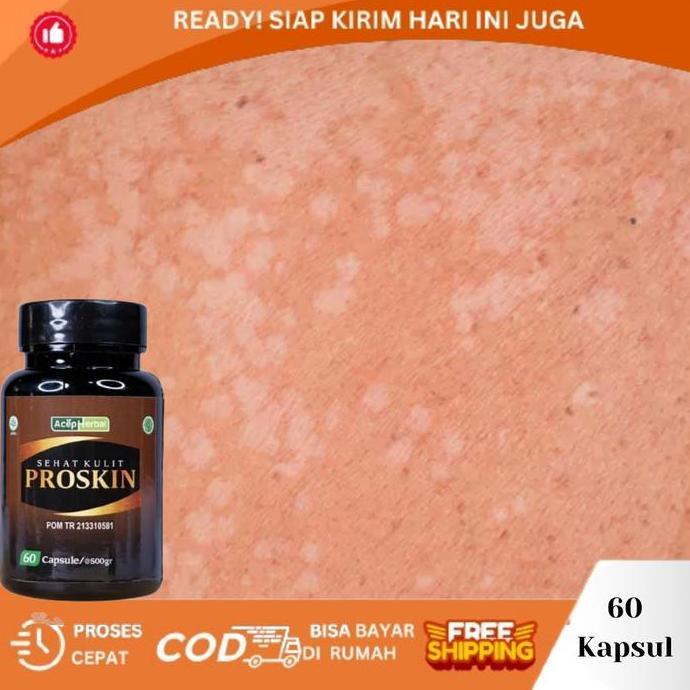 Proskin Gatal Jamur Kulit Panu, Penyakit Putih Di Kulit, Hapuran Kulit, Panu di Leher, Panu Di Pungg