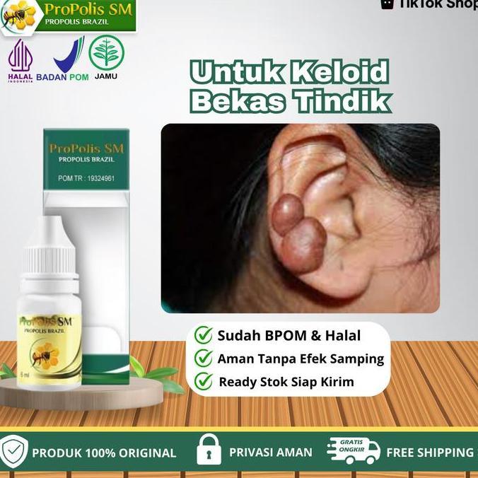 Propolis SM - Untuk Penghilang Keloid Bekas Luka Menonjol Di Telinga,  Keloid Menonjol Bekas Tindik 