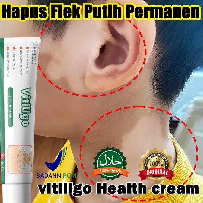 salep khusus bercak putih vitiligo salep vitiligo, bercak-bercak putih vitiligo cream bercakputih pe