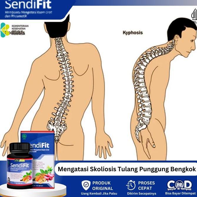 Suplemen Untuk Mengatasi Skoliosis Tulang Belakang Bengkok, Tulang Pinggang Bergeser, Tulang Belakan