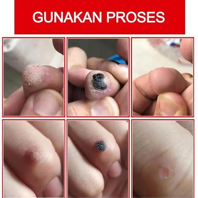 Skin- -Efek Bagus Obat Kutil Paling Ampuh Oles Penghilang Kutil 20G Manjur Tanpa Operasi Mahal Pengh