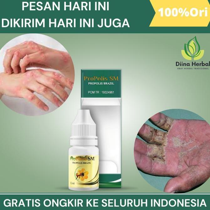 Penghilang Scabies Dan Kutu Hewan Dikulit, Scabies Pada Kulit Manusia, Penghilang Kudis, Gatal Scabi