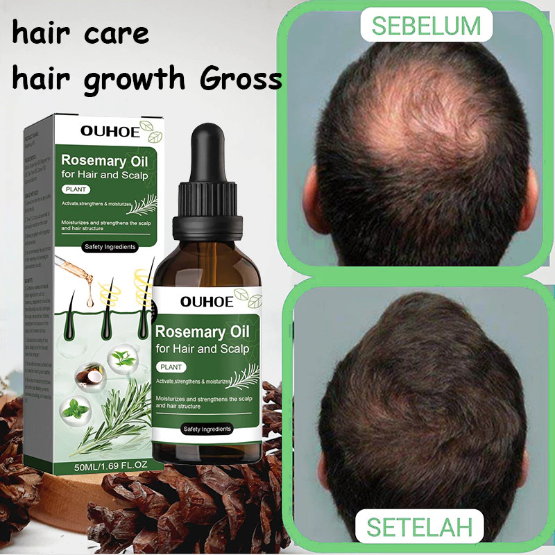 Rambut Botak Cepat Tumbuh Serum Penumbuh Rambut Botak Rosemary Oil Rambut Obat Penumbuh Rambut Hair 