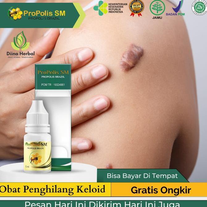 Keloid Menahun, Keloid Berkerut, Penghilang Keloid, Penghilang Daging Jadi, Penghilang Keloid Tahuna