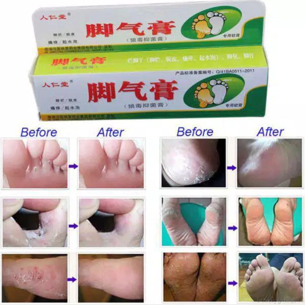NEW OBAT KUTU AIR RAYAPAN RANGEN KAKI KAPALAN PECAH PECAH [terbaik][terlaris]