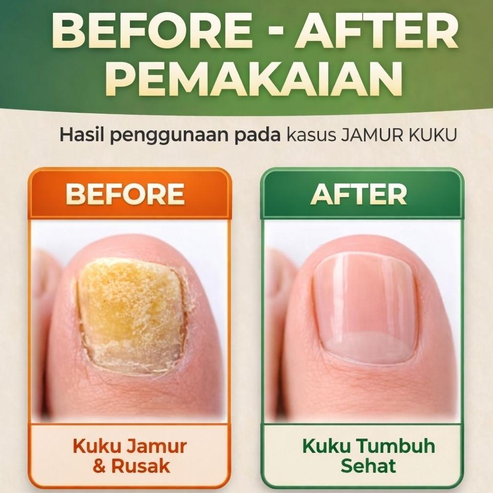 Top Hermoralux Obat Kuku Berjamur Cantengan Kuku Kuning Rusak Penebal Kuku Serum Perawatan Kuku Tang