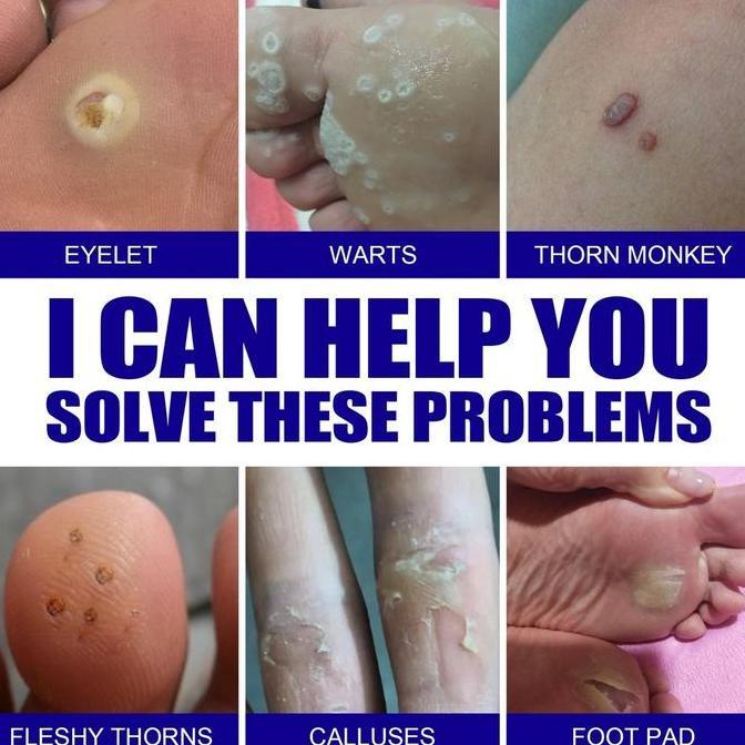 Skinyou- Efek Bagus Obat Kutil Paling Ampuh Oles Penghilang Kutil 20G Manjur Tanpa Operasi Mahal Pen