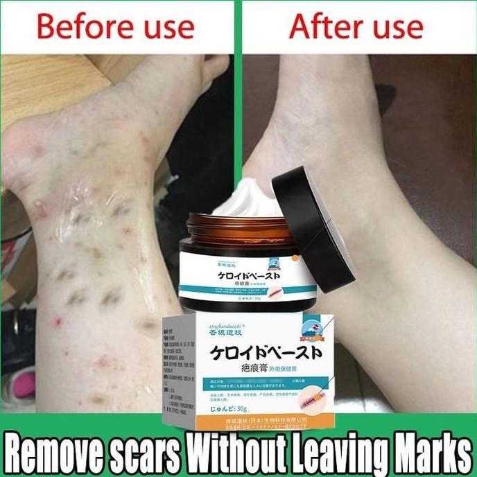 HERBONE Cream Penghilang Bekas Luka Hilangin Bekas Luka Korengan Krim Menghilangkan Bekas Luka Pehil