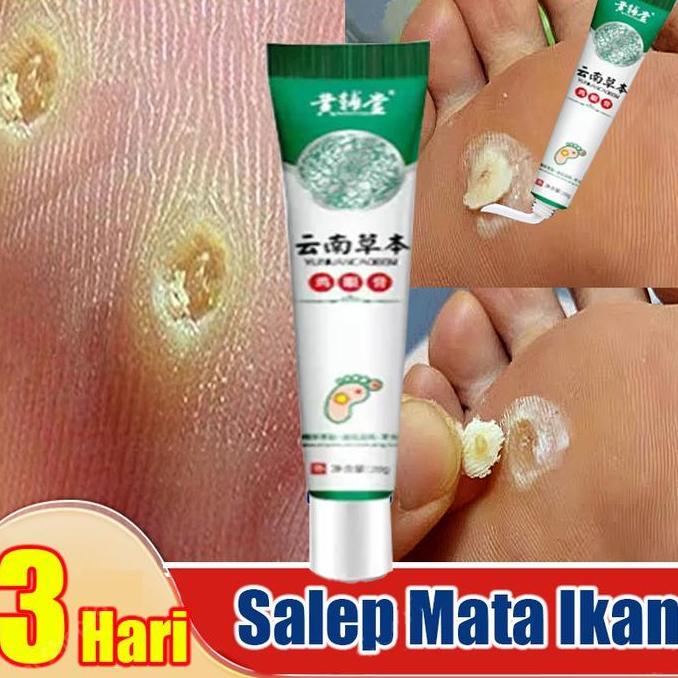 Zena_groupabadi - Salep mata ikan telapak kaki /Obat penyakit mata ikan / Obat Mata Ikan Pada Telapa